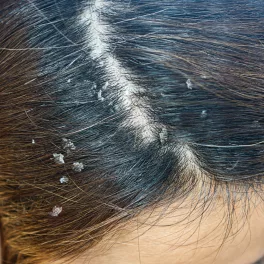 Dandruff
